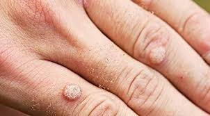 mụn cóc ở tay gây khó chịu, có lây không