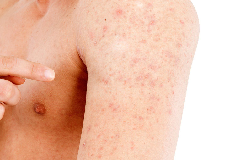bị rôm sảy ở người lớn