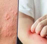 viêm gia cơ địa