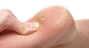 mụn cóc ở chân điều trị như nào
