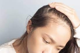 bệnh lý về da là nguyên nhân gây rụng tóc ở nữ giới