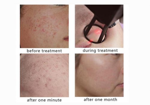 Trẻ hóa da bằng công nghệ Laser Fractional CO2