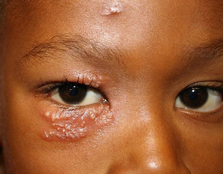 Cách chữa bệnh Zola thần kinh hiệu quả - Giải pháp giúp giảm triệu chứng nhanh chóng