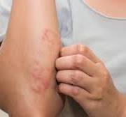 Nổi Mề Đay, Chàm Da Và Chàm Môi – Đừng Chủ Quan!