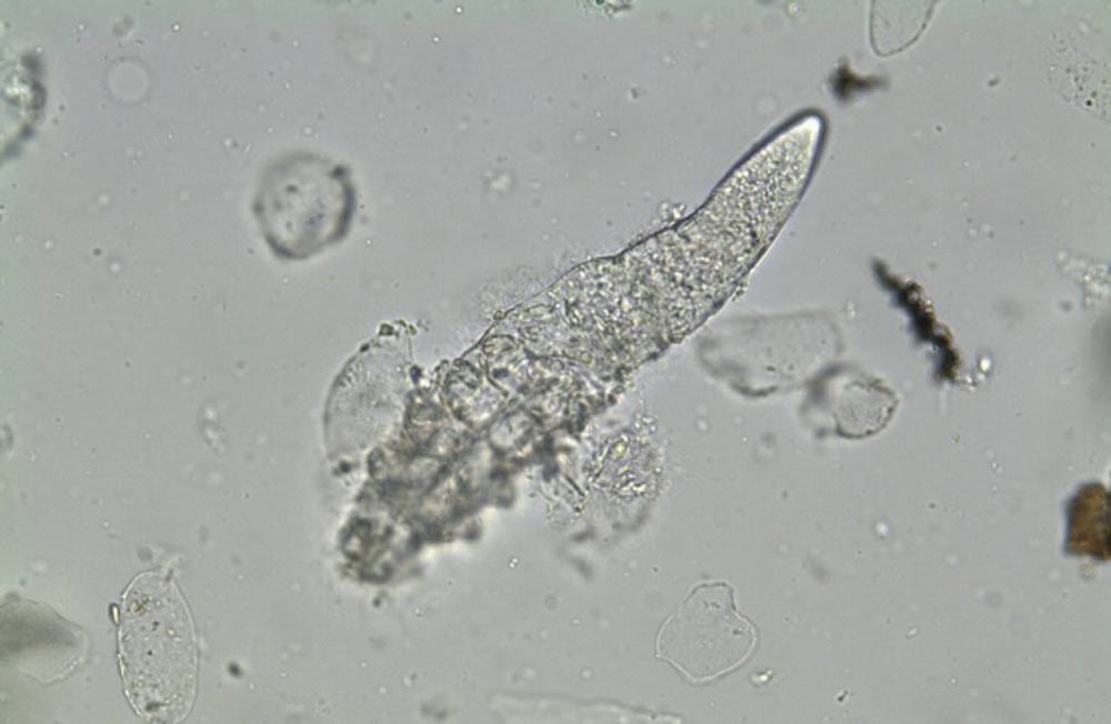 Viêm da do Demodex- Tránh nhầm lẫn với mụn trứng cá