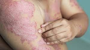 Hắc Lào Là Gì? hắc lào có lây không & Cách Phòng Ngừa