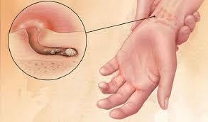 Ghẻ Ngứa Về Đêm Là Bệnh Gì? Hình Ảnh Và Cách Phân Biệt