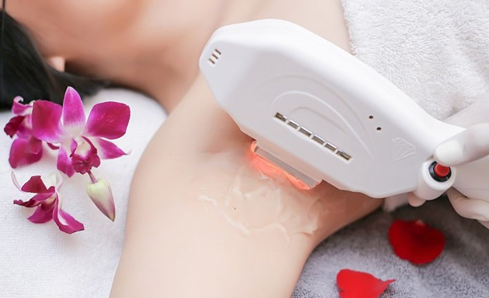 Triệt lông thần tốc với công nghệ IPL