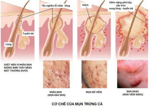 Mụn trứng cá hình thành như thế nào?