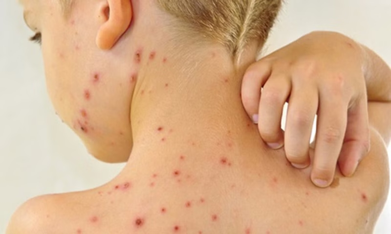 Nổi Mẩn Ngứa: Nguyên Nhân, Triệu Chứng & Điều Trị