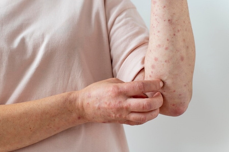  Sốt xuất huyết có lây không, Triệu chứng ở người lớn