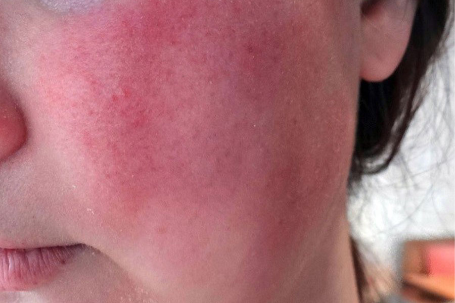 viêm da do sử dụng sản phẩm gia công mỹ phẩm không rõ