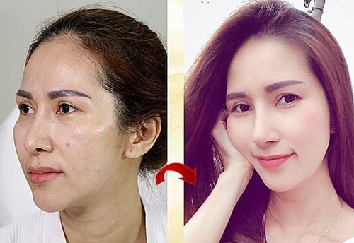 tiêm filler có hại về sau không
