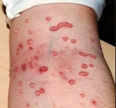 u mềm lây ở trẻ