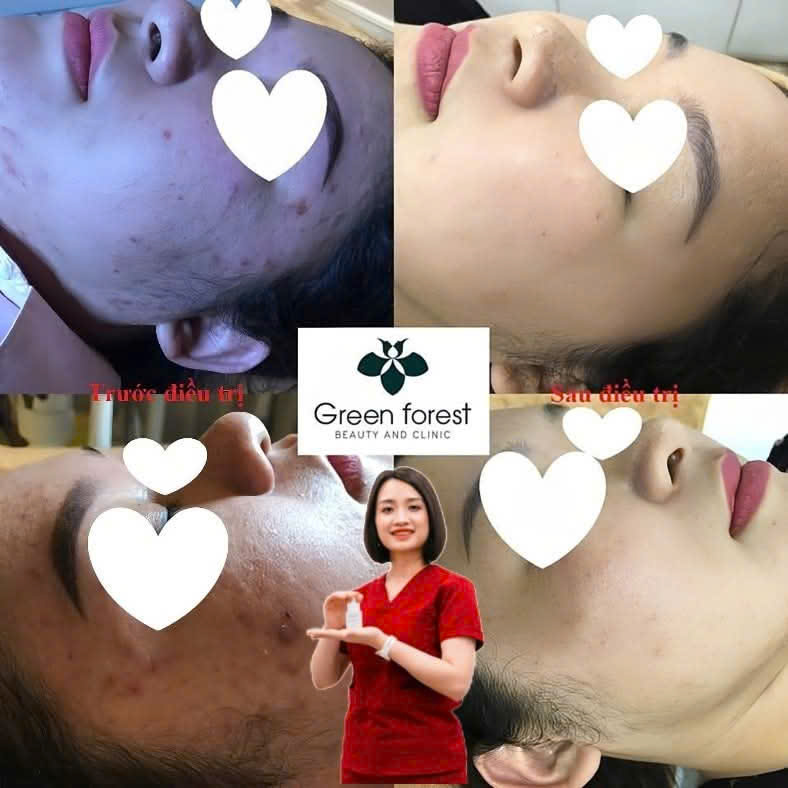 ts bác sĩ hiền điều trị mụn viêm hiệu quả chuẩn y khoa