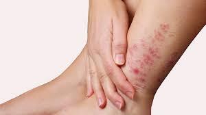 benh nấm da điều trị như nào