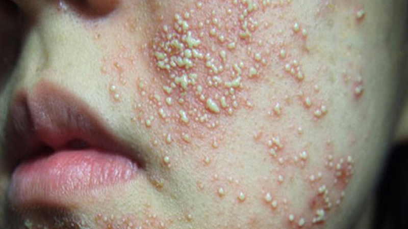 da nhiễm corticoid là gì