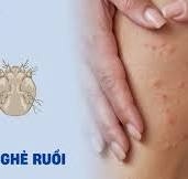 hình ảnh ghẻ ngứa như nào