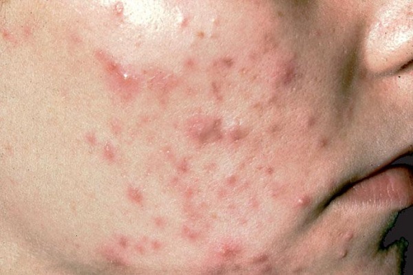 viêm da do vi khuẩn demodex