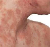 hình ảnh viêm da cơ địa ở người lớn