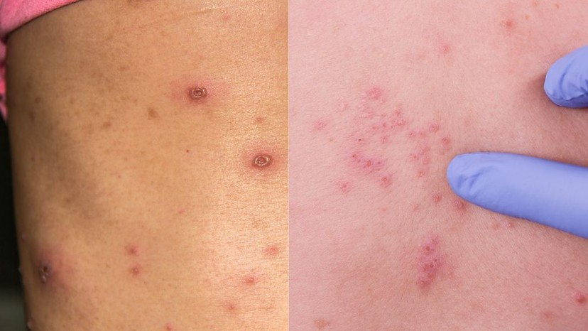 Hình Ảnh Bệnh Thủy Đậu Ở Người Lớn