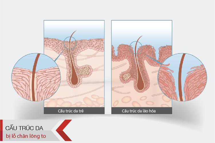 lỗ chân lông của mụn viêm như nào