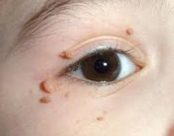 mụn cóc lây không