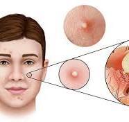 nổi mụn do đâu