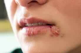 Herpes Là Gì