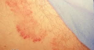 cách trị nấm bẹn