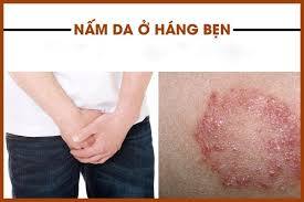 nấm bẹn