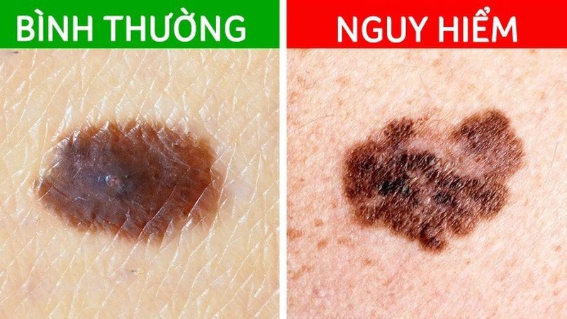 Nốt Ruồi Trên Mặt Phụ Nữ
