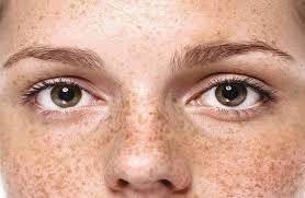 Cách Trị Tàn Nhang Tại Nhà