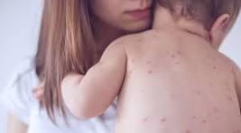 triệu trứng bệnh sởi