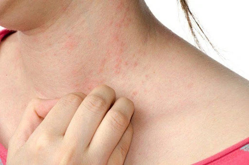 hình ảnh viêm da dị ứng