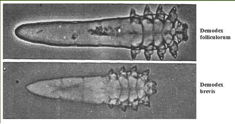 vi khuẩn demodex gây ngứa da