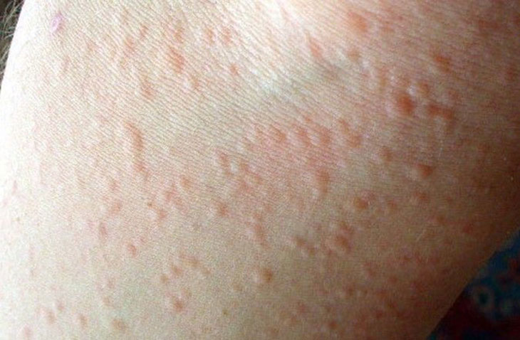 viêm da dị ứng thời tiết