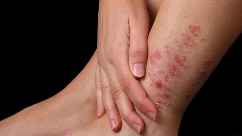 Ghẻ Ngứa Tự Khỏi Không? Hình Ảnh, Địa Chỉ Da Liễu Gần Đây Uy Tín